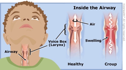 Croup illustration - KidsHealth Nemours Croup illustration - KidsHealth Nemours